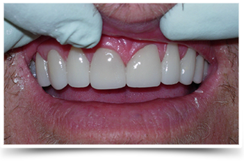 Photo of teeth after smile makeover