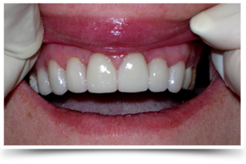 Photo of teeth after smile makeover