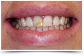 Photo of teeth after smile makeover