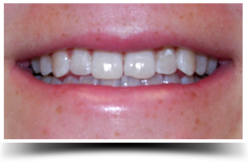 Photo of teeth after smile makeover