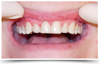 Photo of teeth after smile makeover